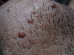 Soldering papilloma