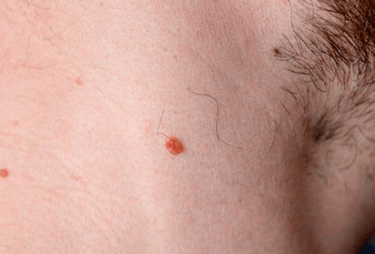 Papilloma