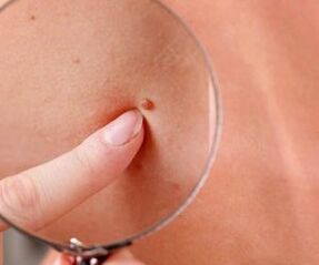 Manifestations of the human papilloma virus