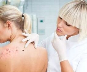 Symptoms of human papilloma virus