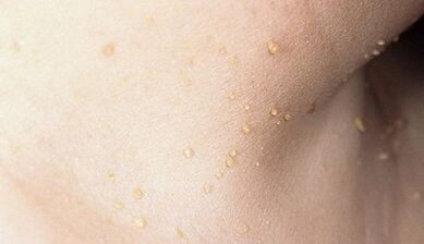 Risk of papillomatosis of the neck