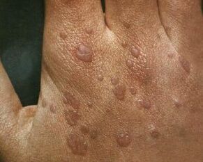 Causes of warts