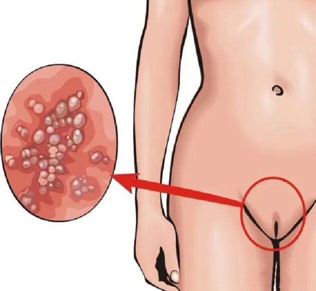 Papillomas in the perineum