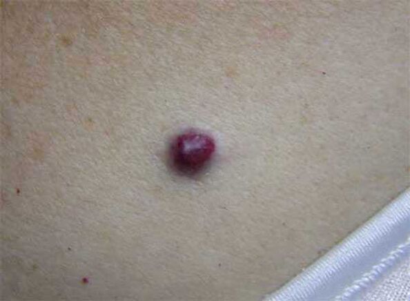 Red birthmark on body