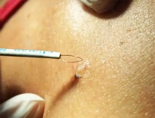 Removal of papillomas