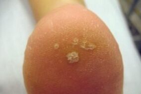 Plantar wart