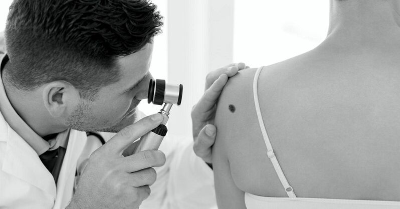 A specialist diagnoses the type of wart