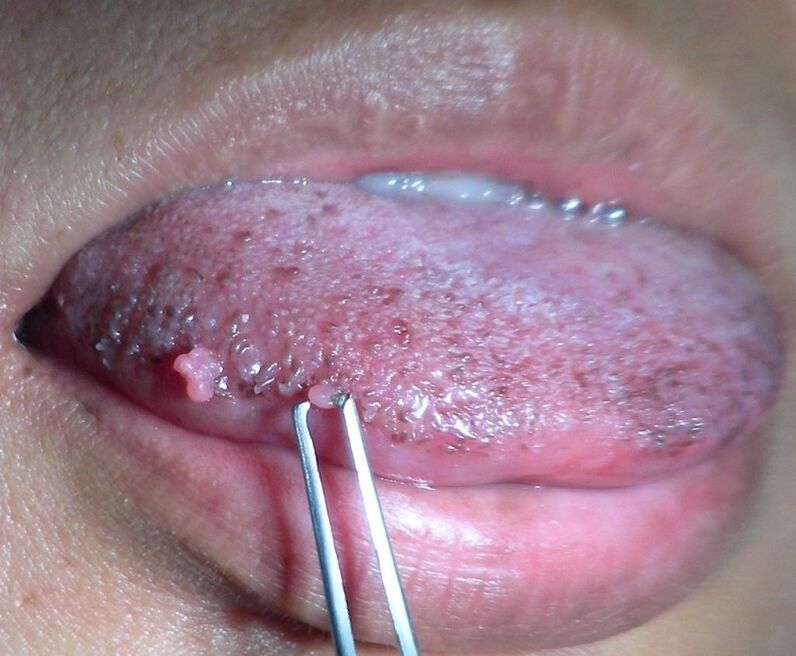 Condyloma on the tongue