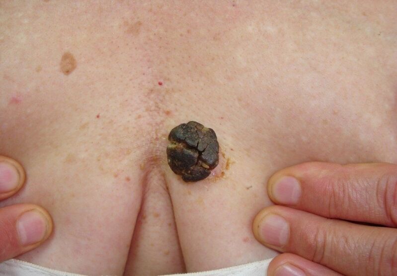 Keratoma on the human body