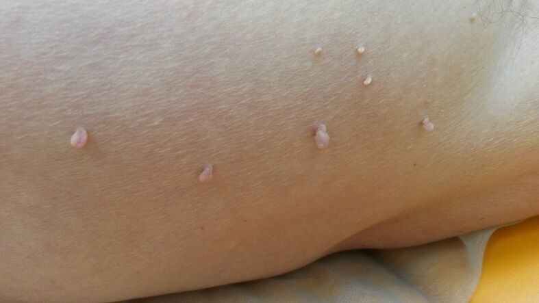 Papillomas on the human body