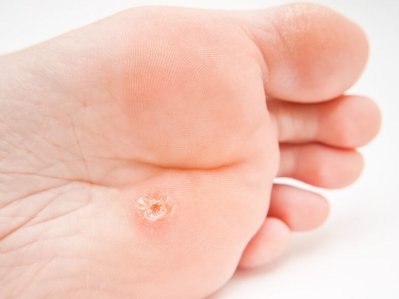 Plantar wart on foot