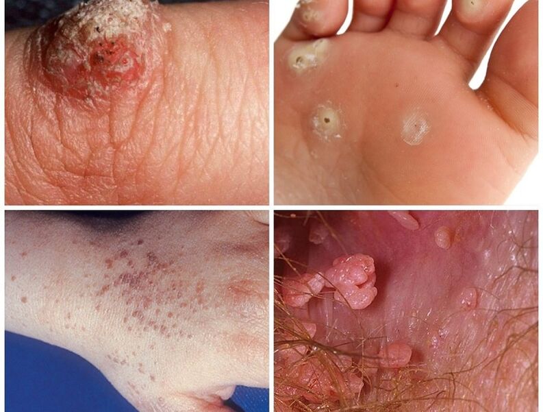 Types of warts on the human body