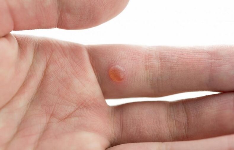 common wart on finger