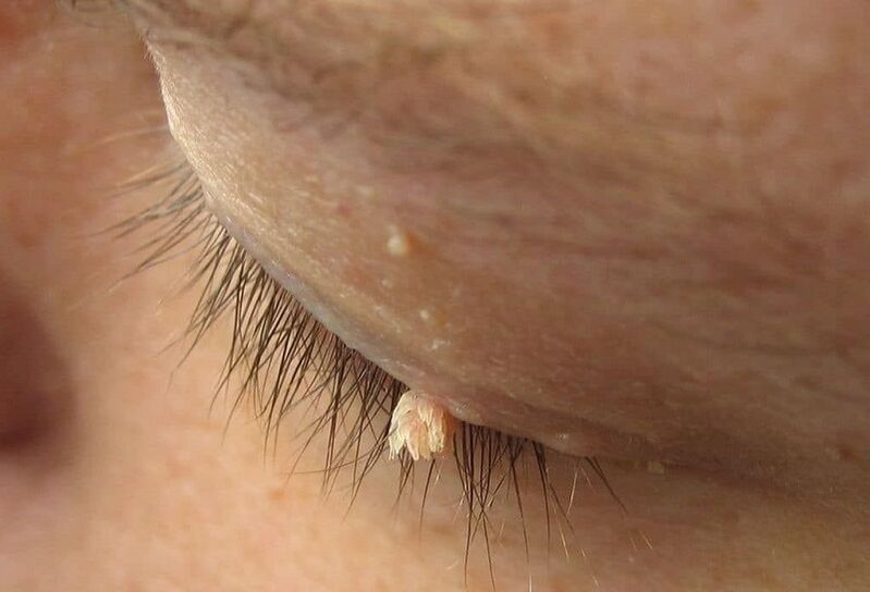 thread-like wart on the eyelid
