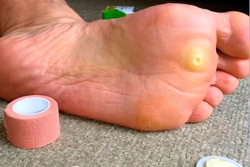 Plantar wart on foot