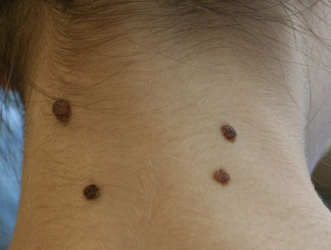 What do papillomas on the neck look like
