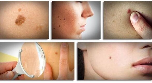 Types of viral papillomas on the body