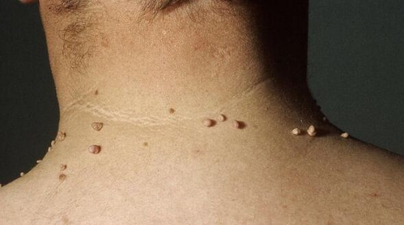 thread-like papilloma on the neck