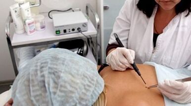 Electrocoagulation as a method for removing warts