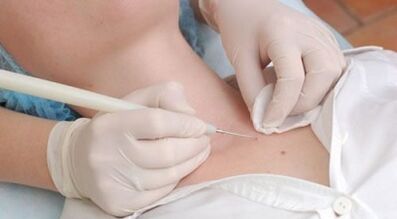 Laser removal of warts