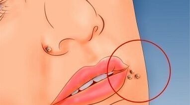 The reasons for the appearance of warts